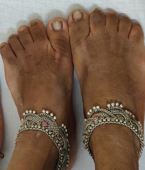 Acromegaly of feet.